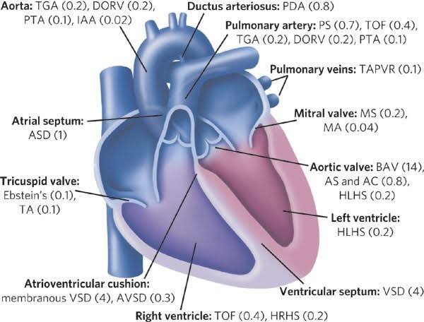 Congenital Heart Defects