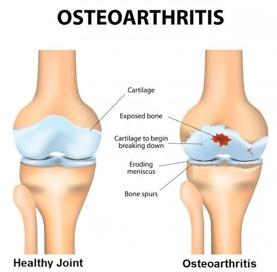 Osteoarthritis