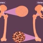 osteomalacia
