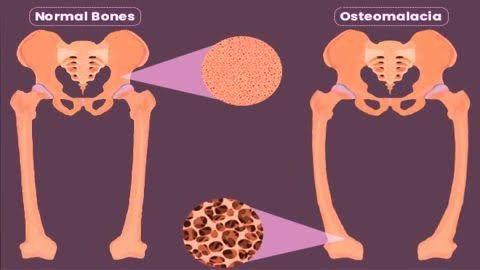 osteomalacia